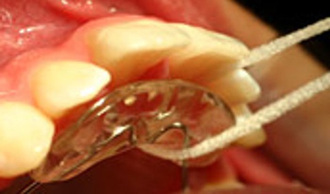Tandtråd i en mun som har tandställning.