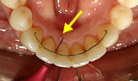 Insidan av en mun som använder mellanrumsborste 