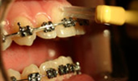 Bild på mun med fast tandställning, som borstar tänderna