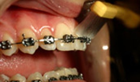 Bild på mun med fast tandställning, som borstar tänderna
