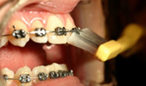 Bild på mun med fast tandställningBild på mun med fast tandställning, som borstar tänderna