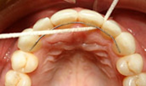En mun som använder tandtråd