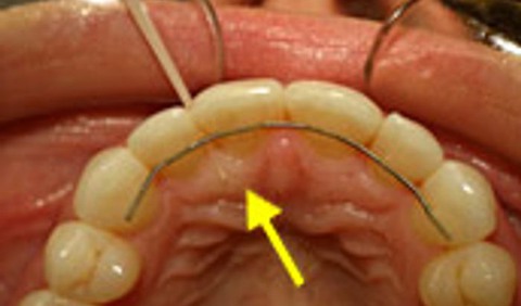 En mun som använder tandsticka