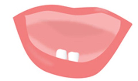 Illustration av en barnmun med två tänder